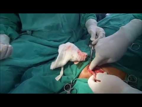 Patient dies during live surgery: AIIMS in tangle Patient dies during live surgery: AIIMS in tangle