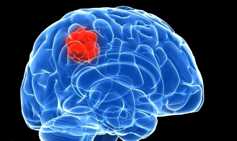 Blood-brain barrier breached for first time to treat cancer Blood-brain barrier breached for first time to treat cancer