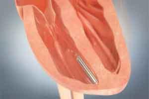 LEADLESS: The next generation pacemakers?? LEADLESS: The next generation pacemakers??