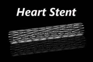 High Court notice to MCI, CSI, Health Ministry on Alleged practice of Unnecessary Stenting High Court notice to MCI, CSI, Health Ministry on Alleged practice of Unnecessary Stenting